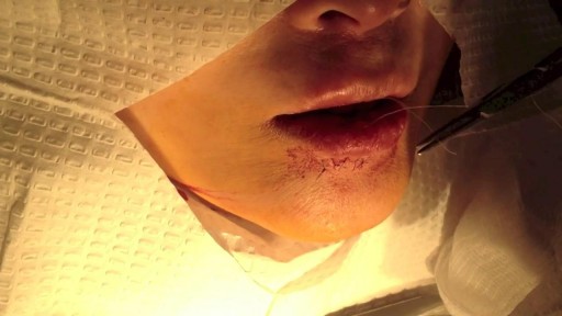 Lip Laceration repair