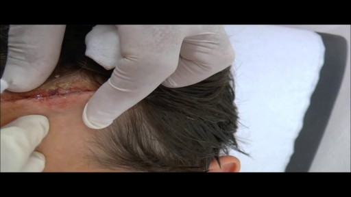 ⁣Forehead wound repaired