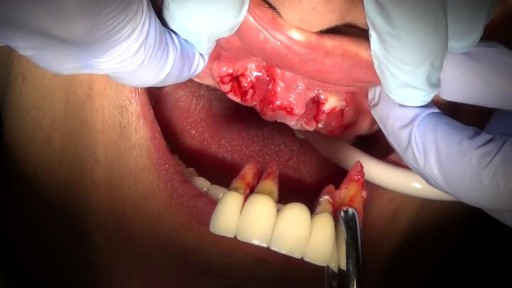 ⁣Advanced periodontal disease.
