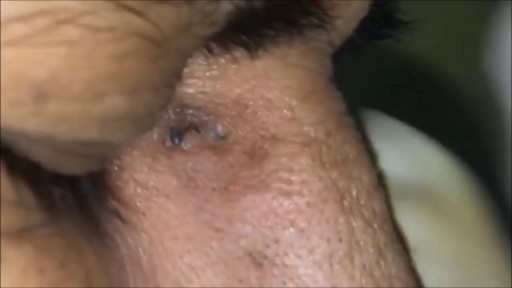 Blackhead Removal