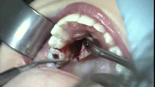 ⁣Wisdom Tooth Extraction Surgery