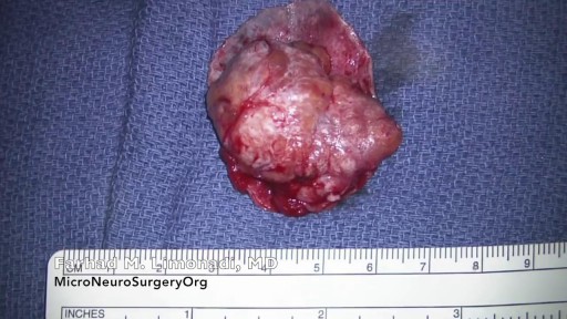 ⁣Removal of large brain tumor (meningioma)