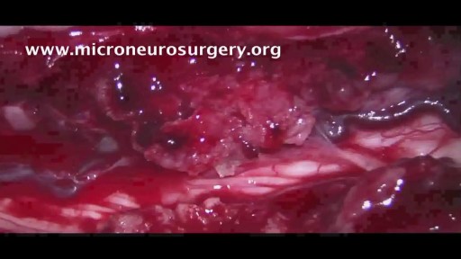 ⁣Spine Tumor Surgery