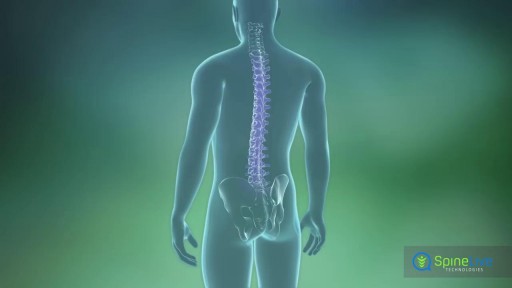 Spinal Tumor Symptoms