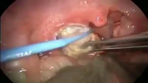 ⁣Tonsil Stone Removal Procedure