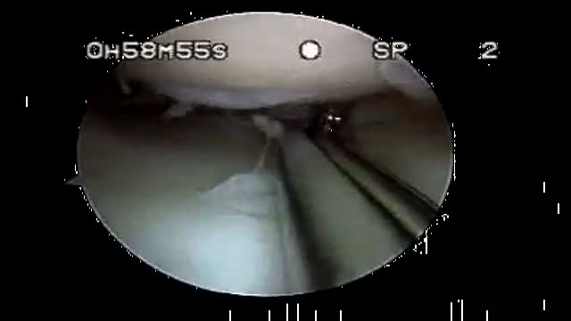⁣Meniscus allograft transplantation - 3 Tunnel Technique