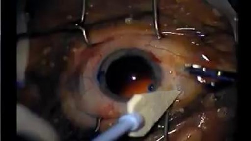 ⁣Amazing Cataract Surgery