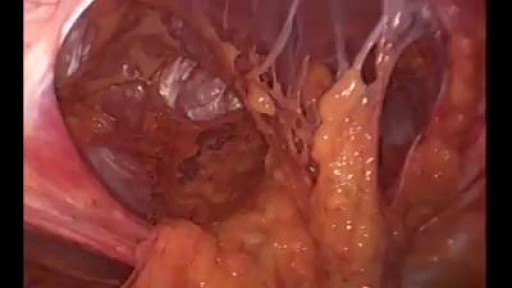 Huge Hernia Repair