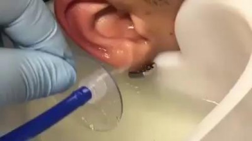 GIANT EAR WAX REMOVAL