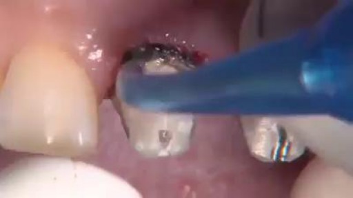 ⁣Replacing PFM Crowns on Teeth