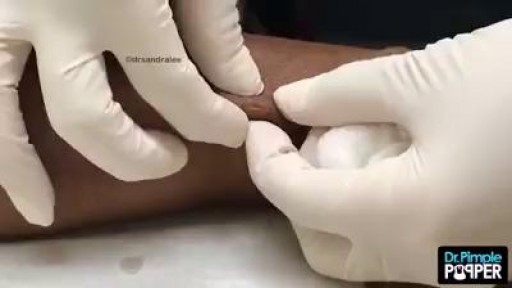 Epidermal Cyst