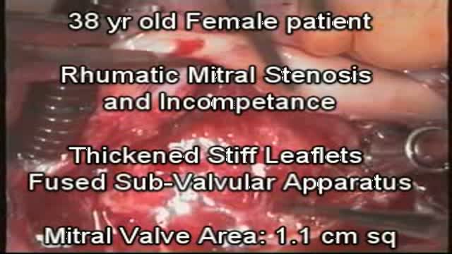 Rheumatic Mitral Valve Repair