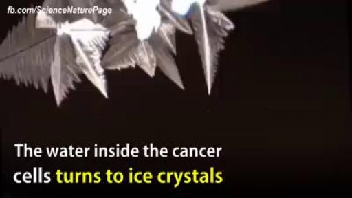 ⁣This device can freeze breast cancer