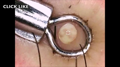 ⁣Blackheads, Whiteheads and Cysts!