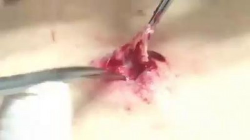 What is inside A Cyst?