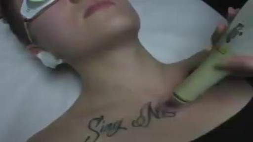 Laser tattoo removal