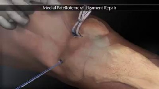 ⁣Medial Patellofemoral Ligament Repair
