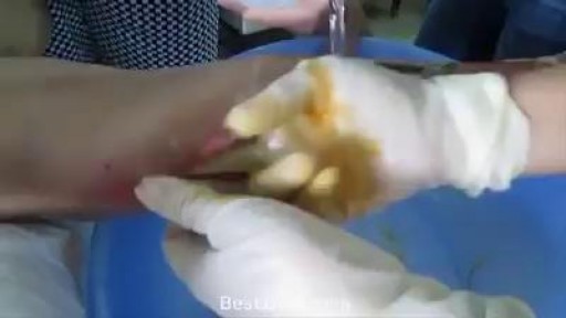 ⁣Cleaning Horrible Infected Skin Cut