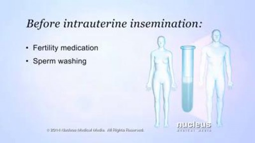 ⁣Intrauterine Insemination procedure