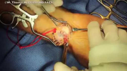 ⁣Ganglion Cyst Surgery