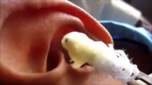 Ear Infection with  pus leaking