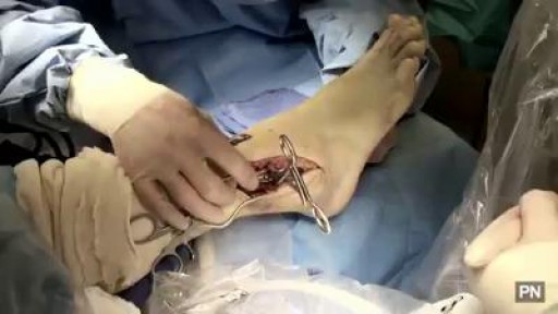 ⁣Ankle Fracture Surgery.