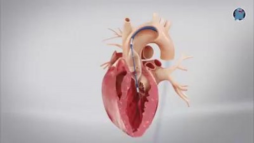 ⁣Transcatheter Aortic Heart Valve