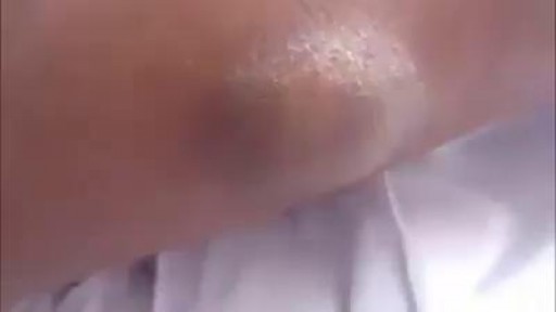 Sebaceous Cyst Removal