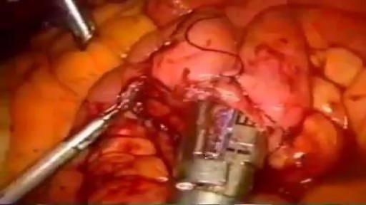 ⁣Gunshot Wound Repairing Surgery Video