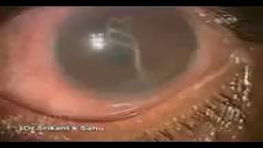 Tapeworm in eye