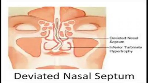 ⁣Deviated nasal septum Surgery