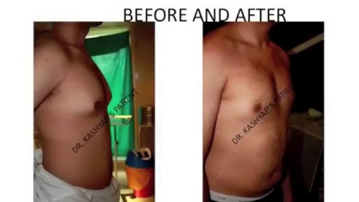 Scar Less Gynecomastia Surgery in Delhi / Male Breast Reduction Surgery in India by Dr Ajaya Kashyap