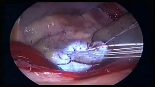 Suturing Heart Valve