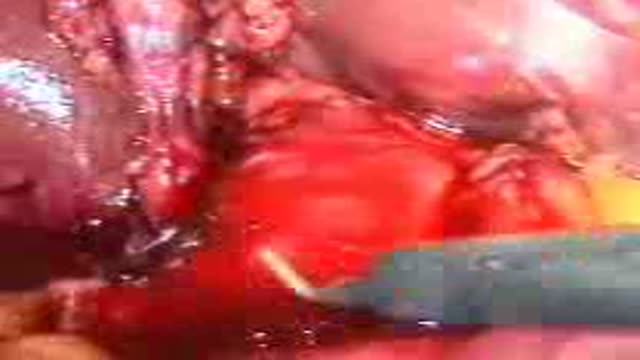 Laparoscopic Choledocolithotomy