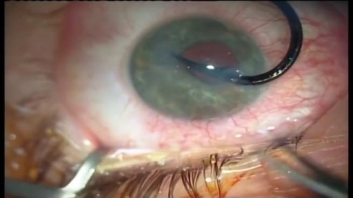 Fishing Hook Inside Eye Removal Surgery