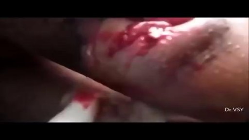⁣Horrible Abscess On Thigh
