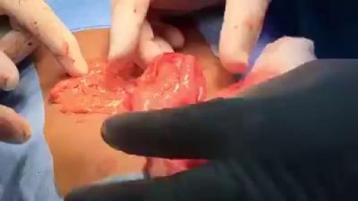 ⁣Removing Giant Hair Ball Inside Human Stomach
