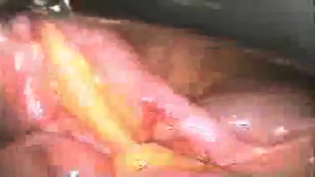 Laparoscopic Appendectomy Surgical Video