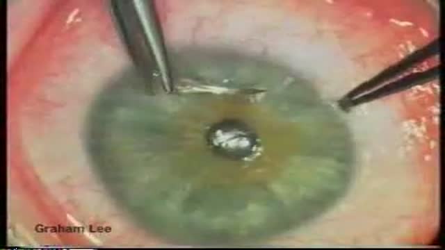 ⁣Glaucoma Trabeculectomy Surgery