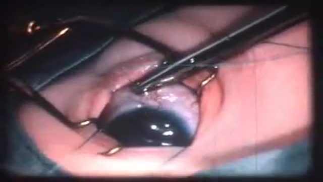 ⁣Goniotomy for Congenital Glaucoma