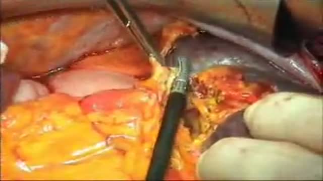 Open Splenectomy