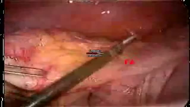 Appendectomy Operation Video