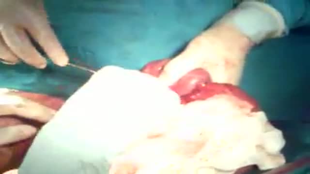 ⁣Intestinal Obstruction Operation