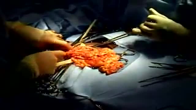 Umbilical Hernia Repair