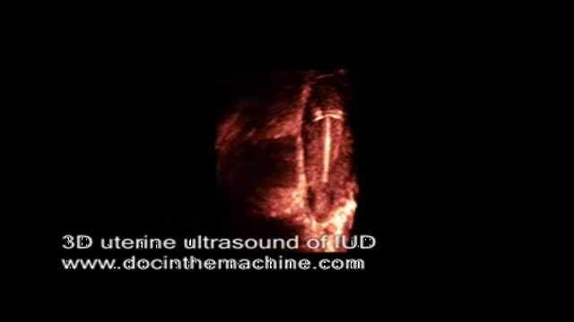 ⁣3D ultrasound of IUD in uterus