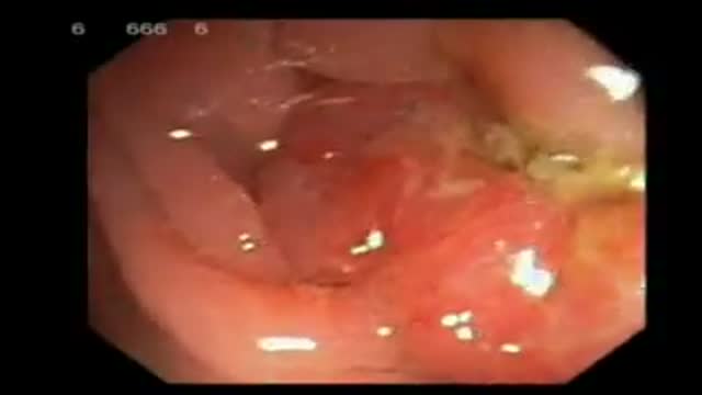 Typical Rectal Cancer Endoscopy