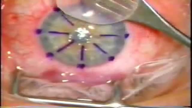 Lamellar Keratoplasty (LK)