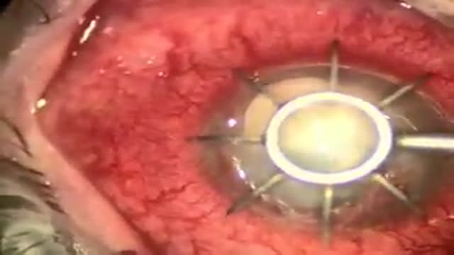 Cornea Transplant