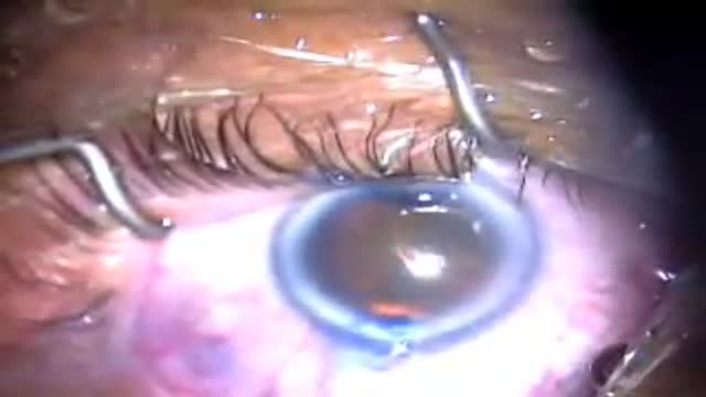 Cataract Surgery with Cloudy Cornea