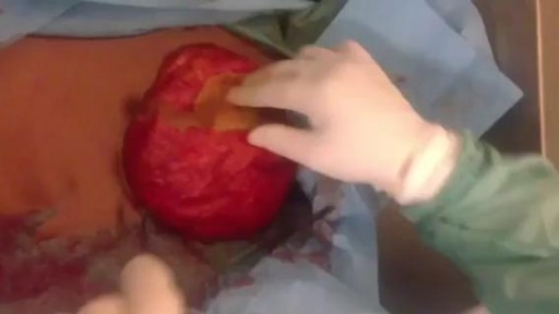 Intracapsula seroma of breast implant